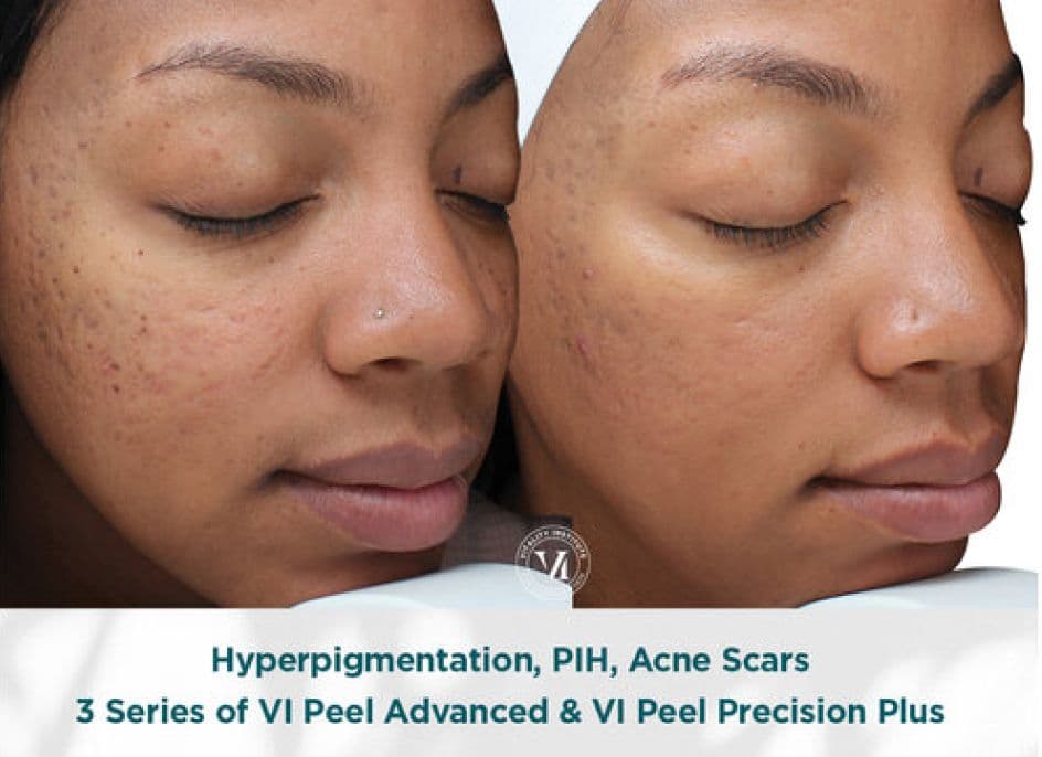 V.i. Peel Advanced  (1)