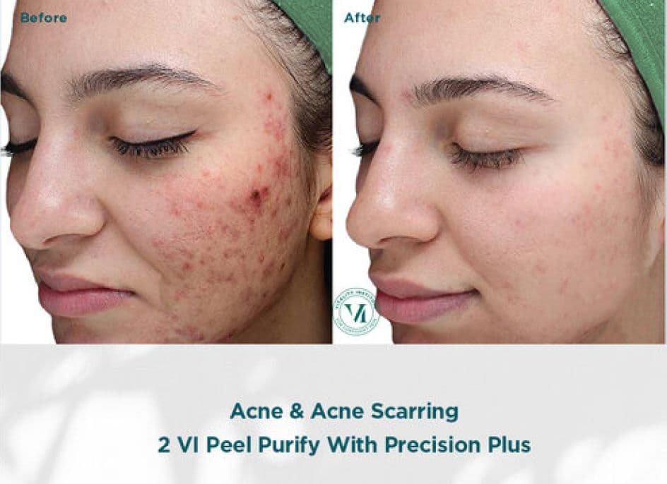 V.i. Peel Purify Precision Plus 